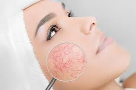 Lotion anti rougeur (couperose) raffermissante